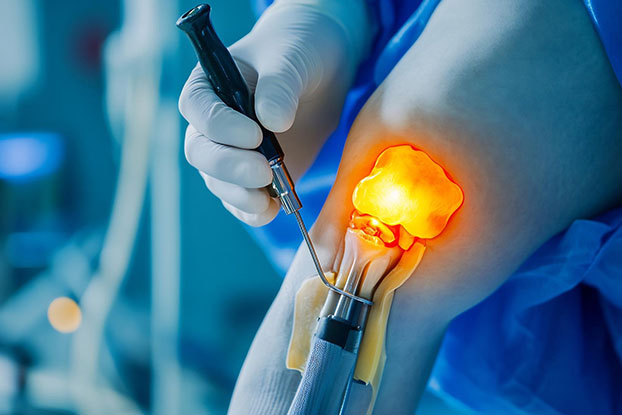 Arthroscopy Surgery
